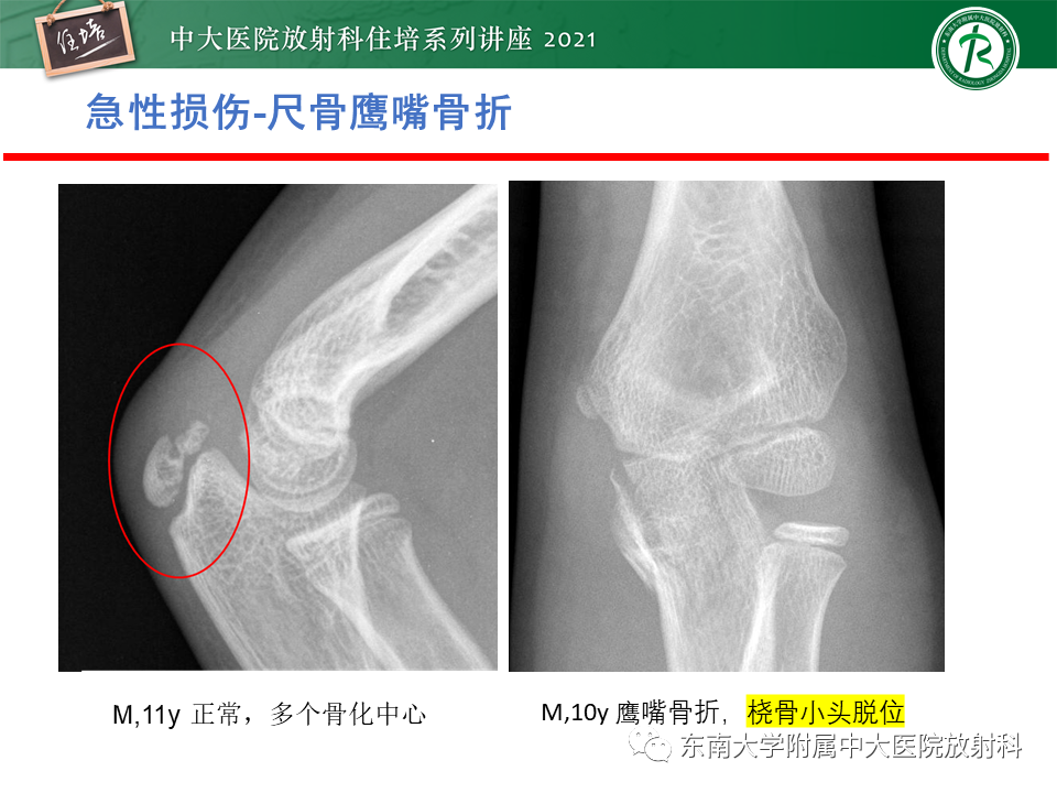 影像PPT - 【PPT】肘关节损伤-30