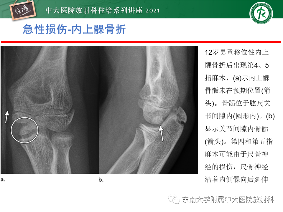 影像PPT - 【PPT】肘关节损伤-28