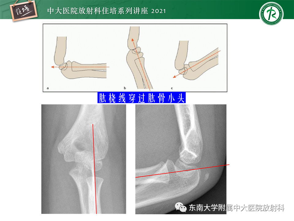 影像PPT - 【PPT】肘关节损伤-33