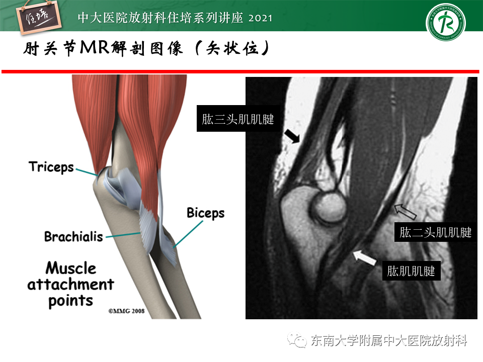 影像PPT - 【PPT】肘关节损伤-41