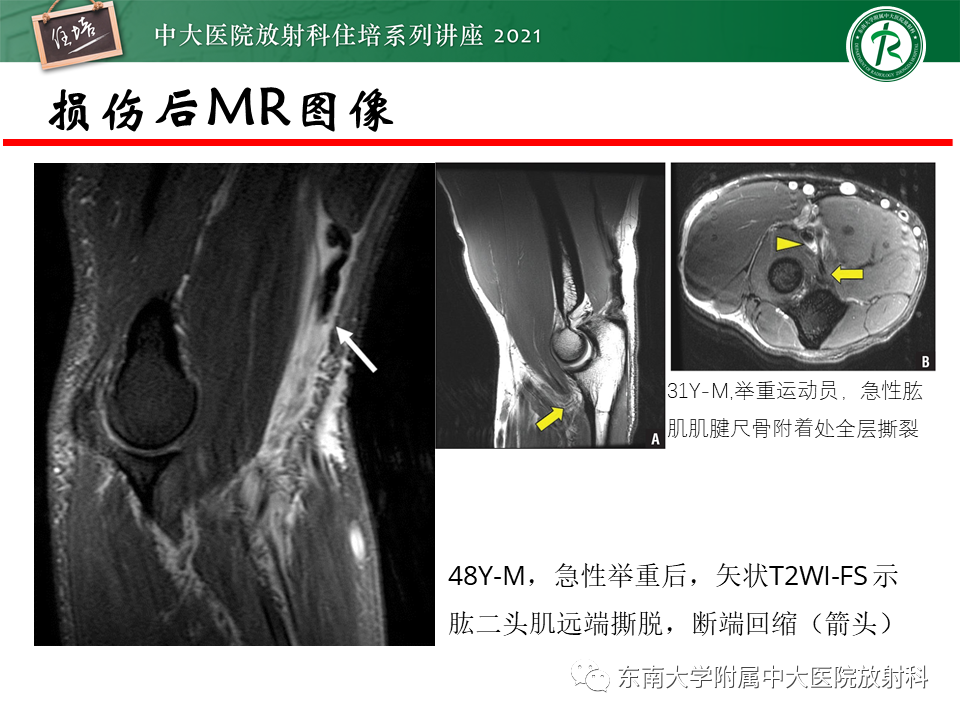 影像PPT - 【PPT】肘关节损伤-43