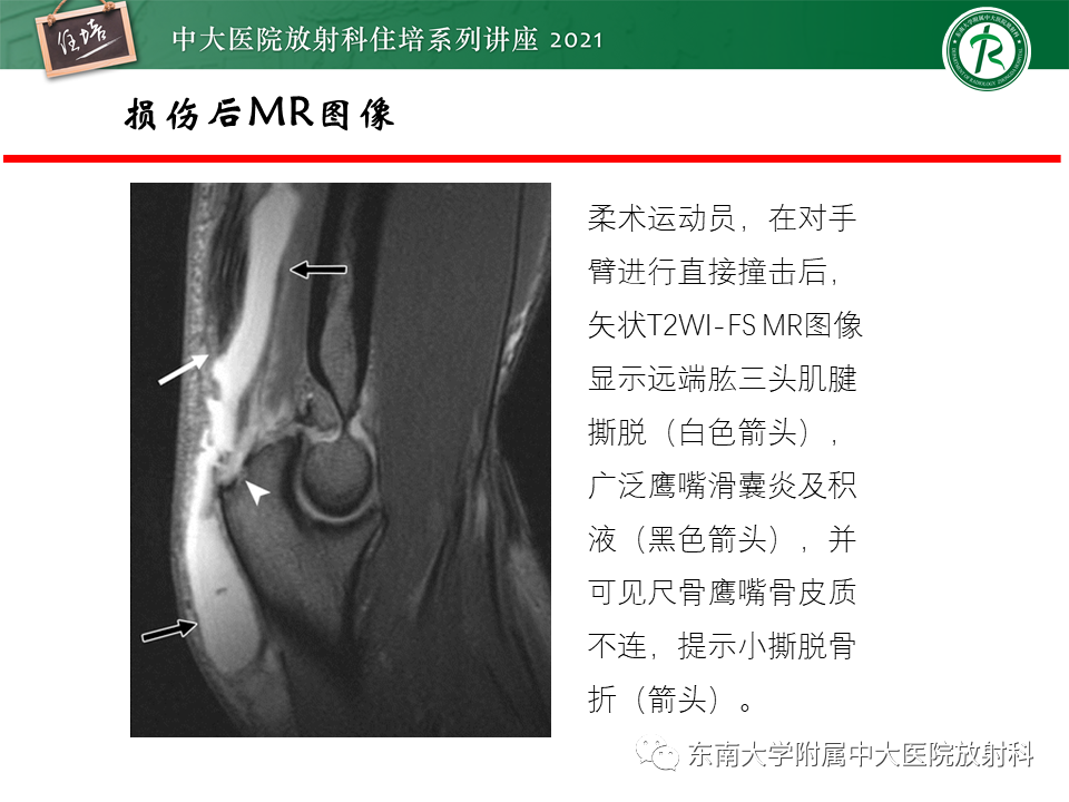 影像PPT - 【PPT】肘关节损伤-45