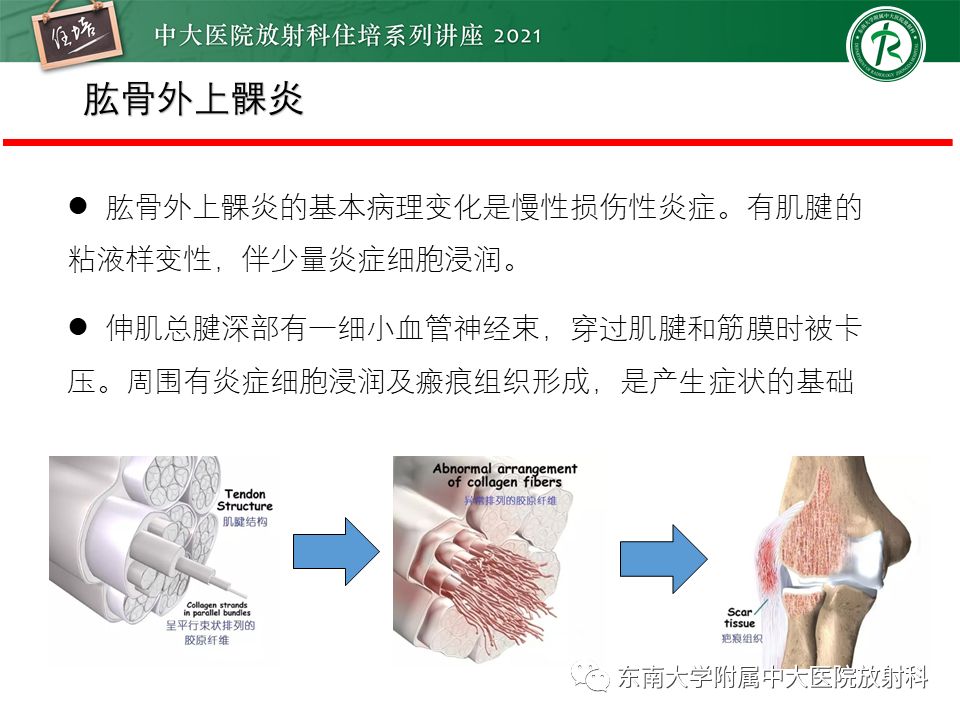 影像PPT - 【PPT】肘关节损伤-48