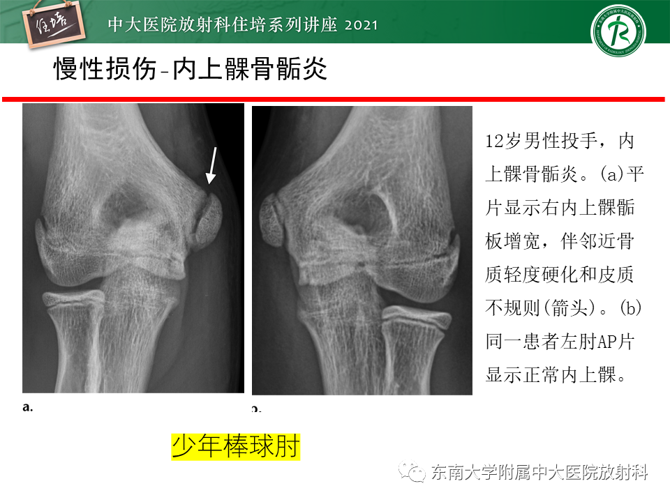 影像PPT - 【PPT】肘关节损伤-53