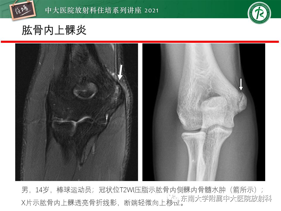 影像PPT - 【PPT】肘关节损伤-55