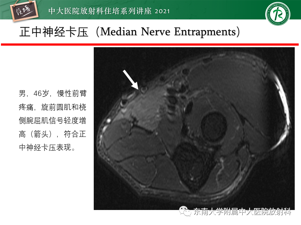 影像PPT - 【PPT】肘关节损伤-61