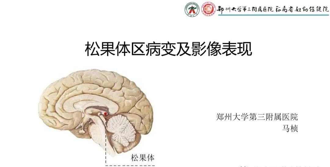 影像PPT - 【PPT】松果体区病变及影像表现-1