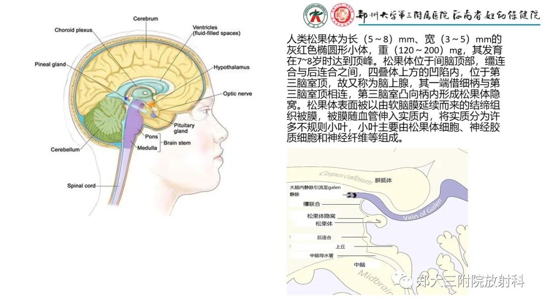 影像PPT - 【PPT】松果体区病变及影像表现-2