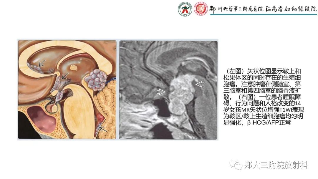 影像PPT - 【PPT】松果体区病变及影像表现-14