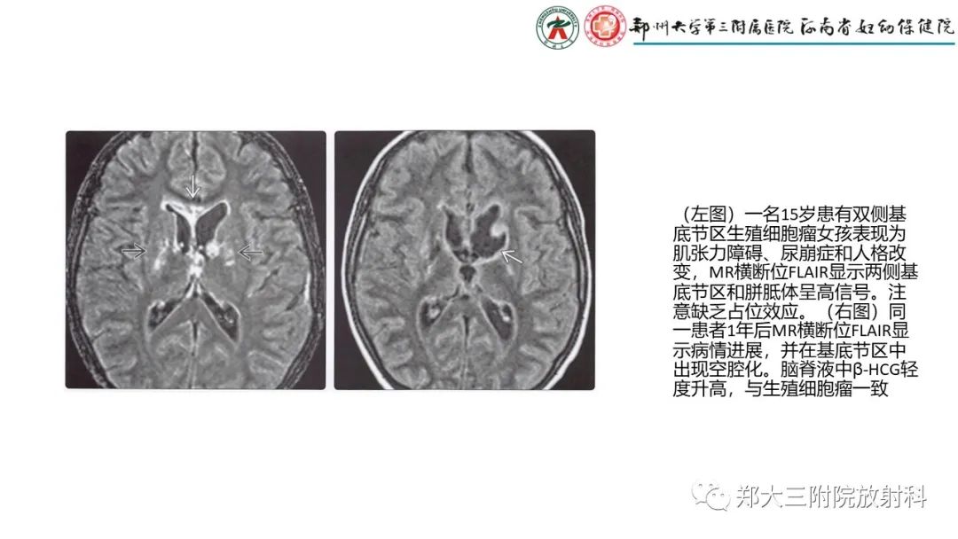 影像PPT - 【PPT】松果体区病变及影像表现-18