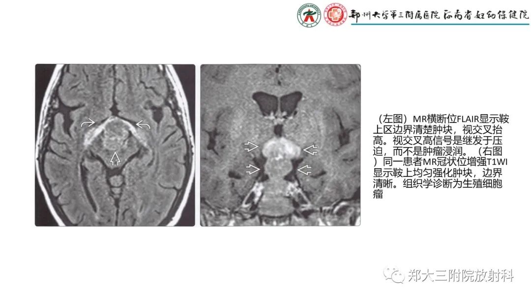 影像PPT - 【PPT】松果体区病变及影像表现-16