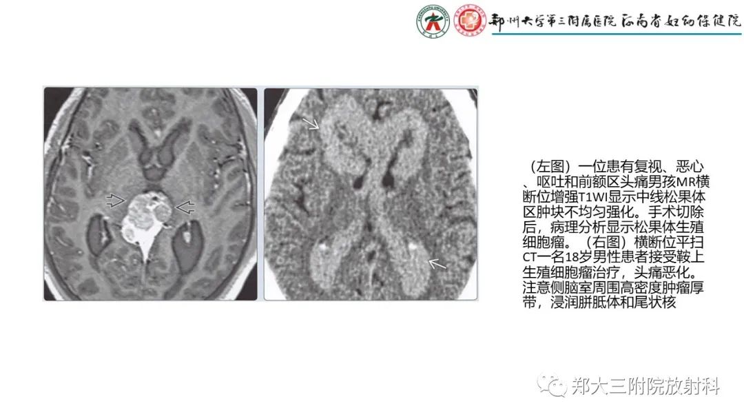 影像PPT - 【PPT】松果体区病变及影像表现-15