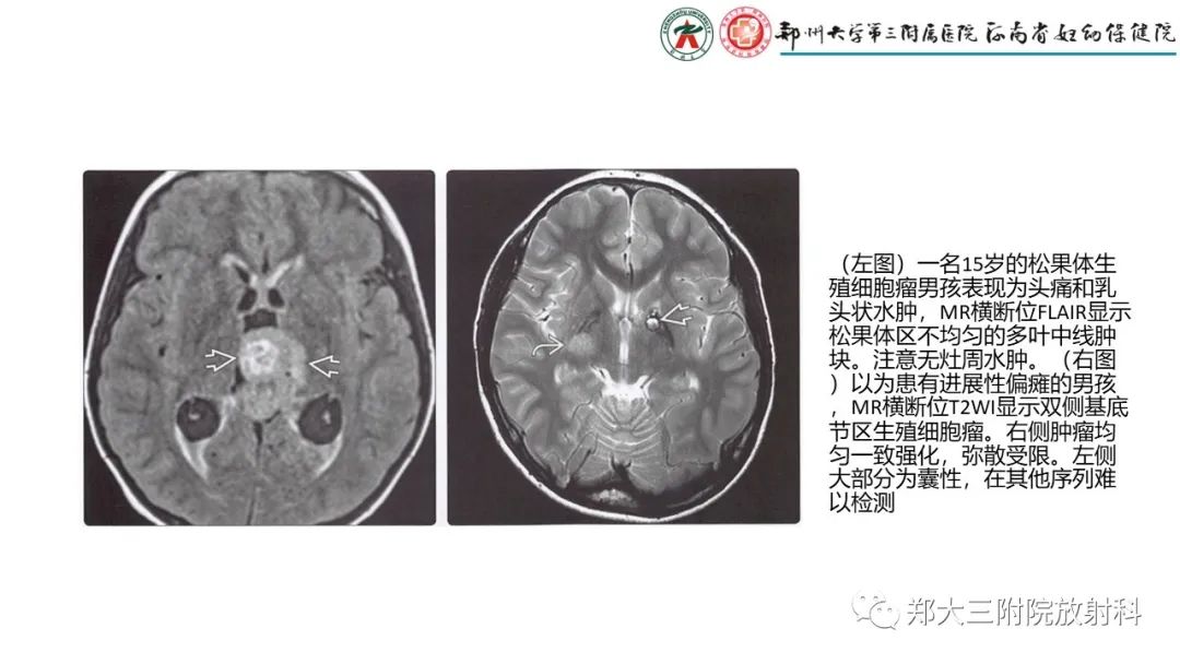 影像PPT - 【PPT】松果体区病变及影像表现-17