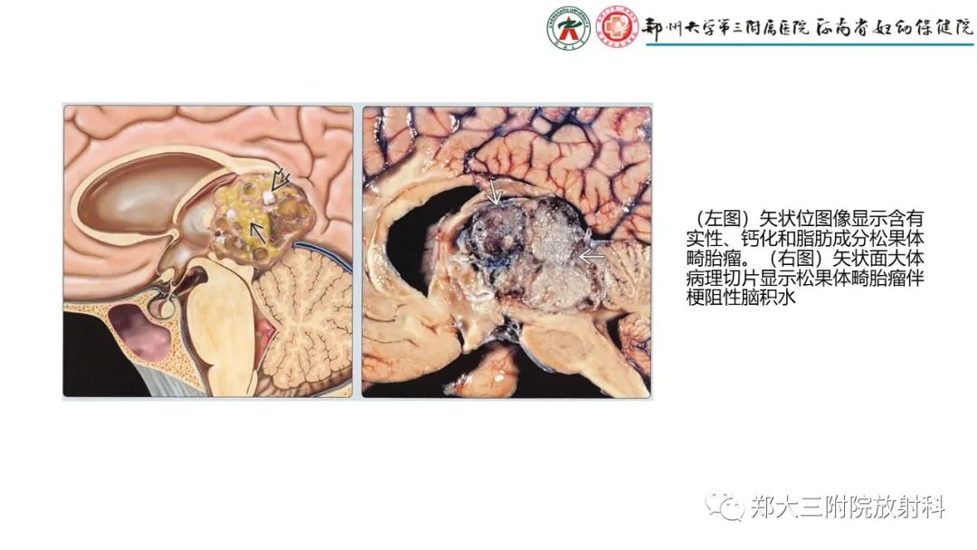 影像PPT - 【PPT】松果体区病变及影像表现-28