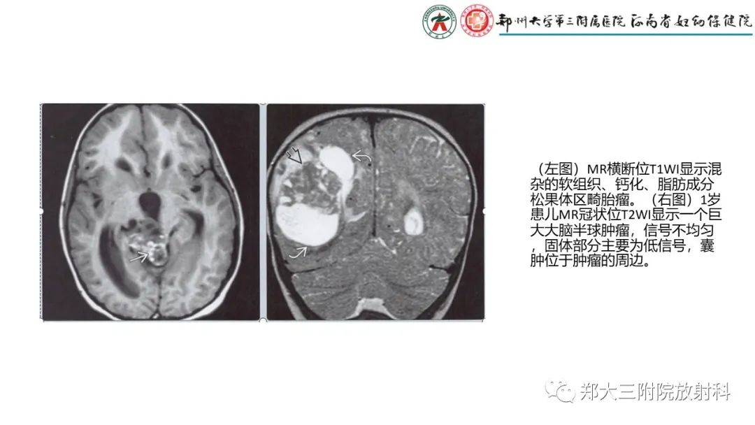 影像PPT - 【PPT】松果体区病变及影像表现-32