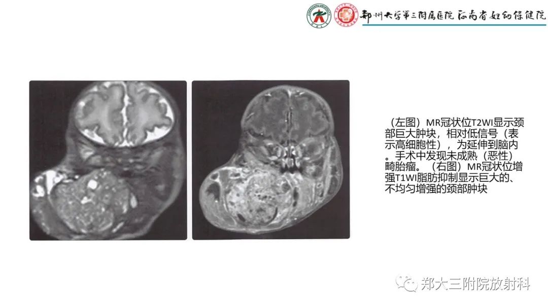影像PPT - 【PPT】松果体区病变及影像表现-33