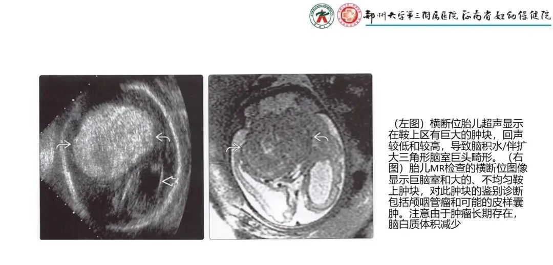 影像PPT - 【PPT】松果体区病变及影像表现-34