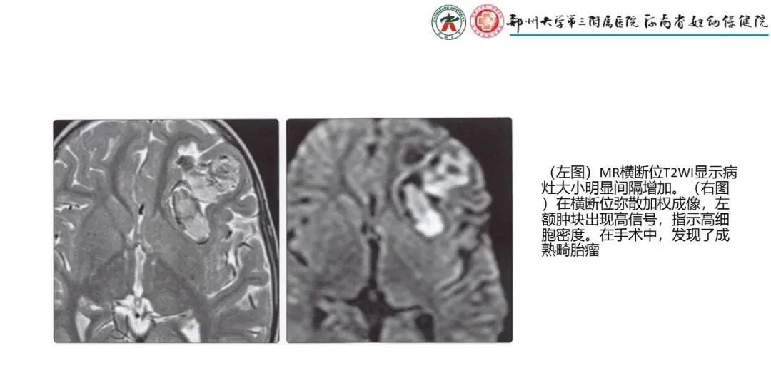 影像PPT - 【PPT】松果体区病变及影像表现-35