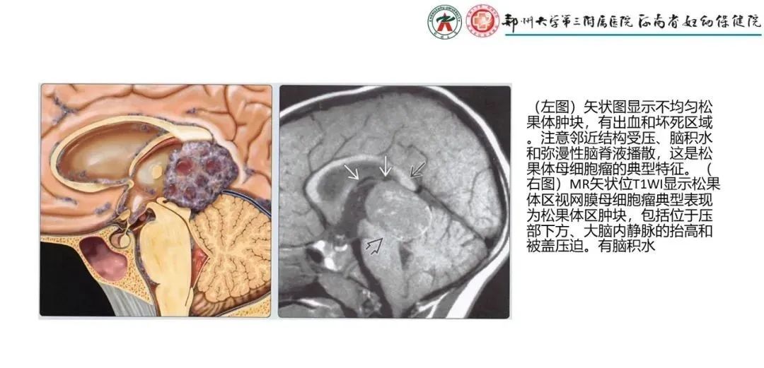 影像PPT - 【PPT】松果体区病变及影像表现-39