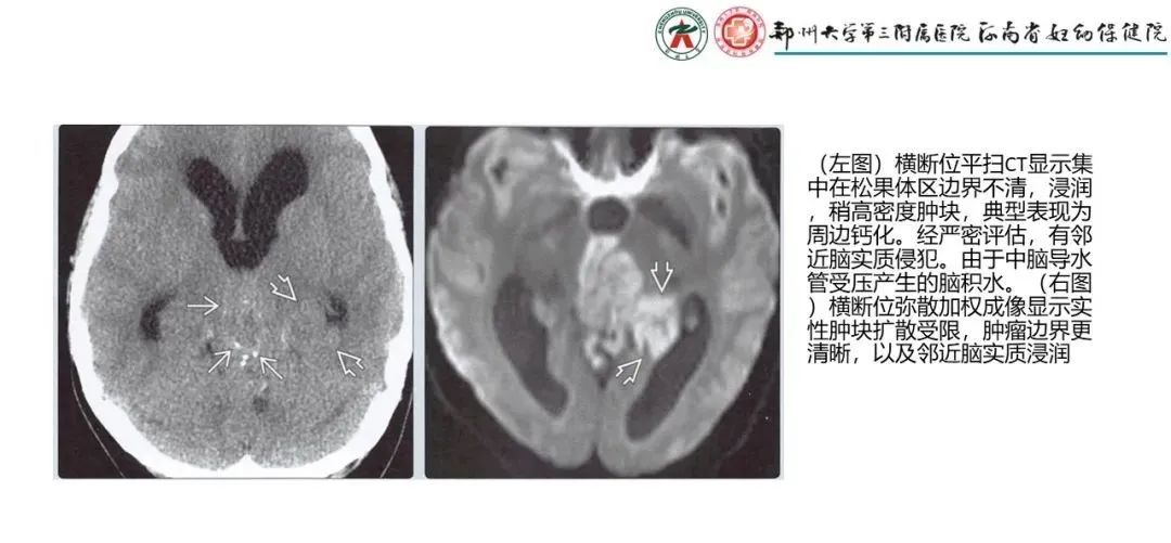 影像PPT - 【PPT】松果体区病变及影像表现-40