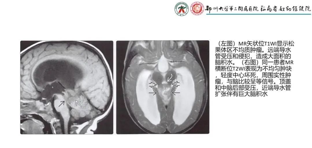 影像PPT - 【PPT】松果体区病变及影像表现-41