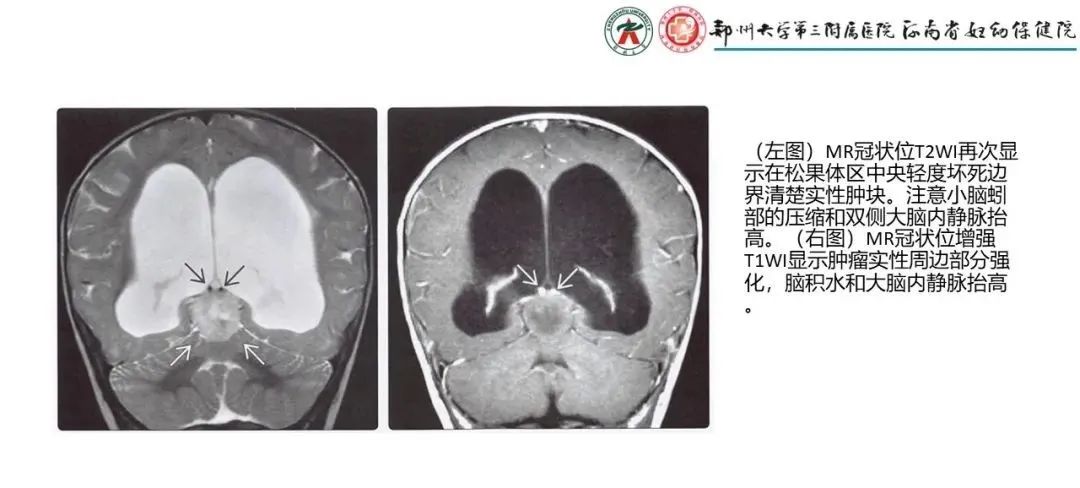 影像PPT - 【PPT】松果体区病变及影像表现-42