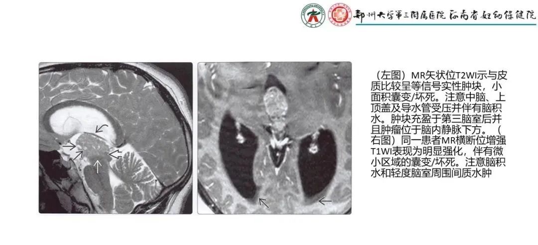 影像PPT - 【PPT】松果体区病变及影像表现-43