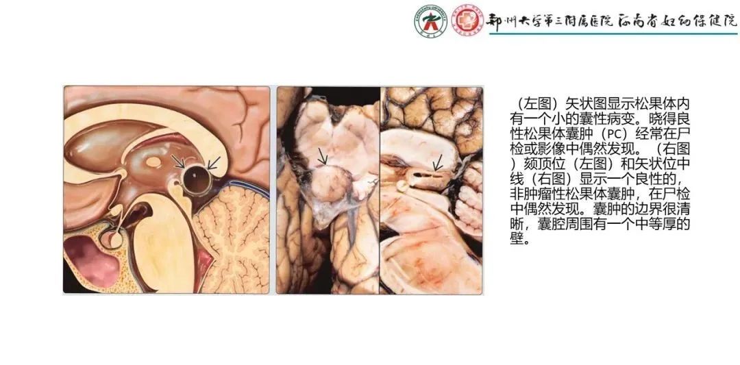 影像PPT - 【PPT】松果体区病变及影像表现-65