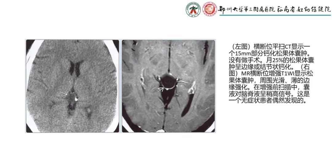 影像PPT - 【PPT】松果体区病变及影像表现-66