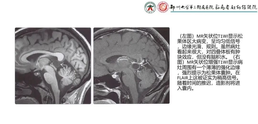 影像PPT - 【PPT】松果体区病变及影像表现-67