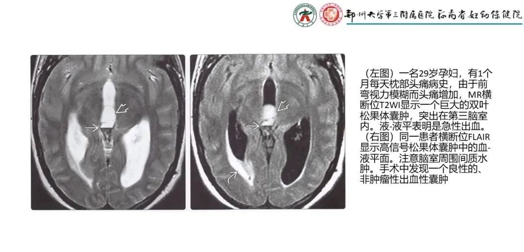 影像PPT - 【PPT】松果体区病变及影像表现-68