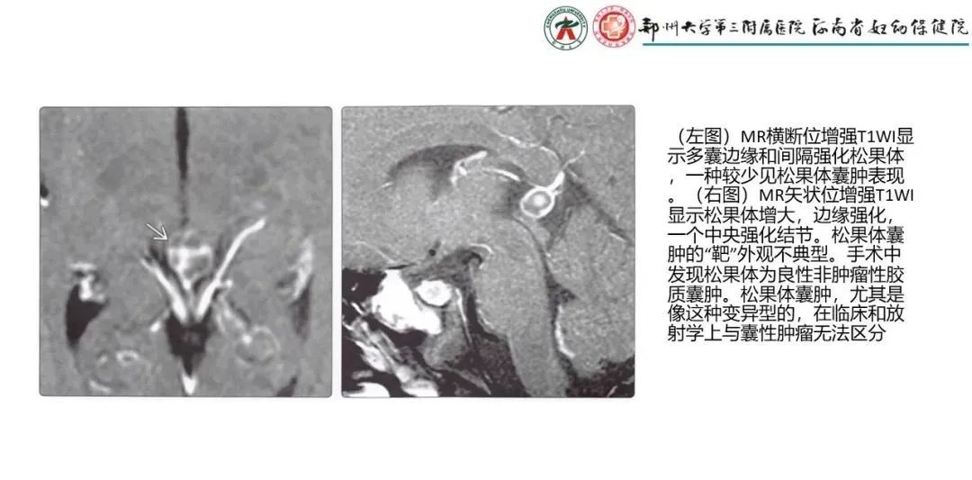 影像PPT - 【PPT】松果体区病变及影像表现-69