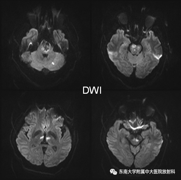 影像PPT - 【PPT】基底动脉尖综合征-1