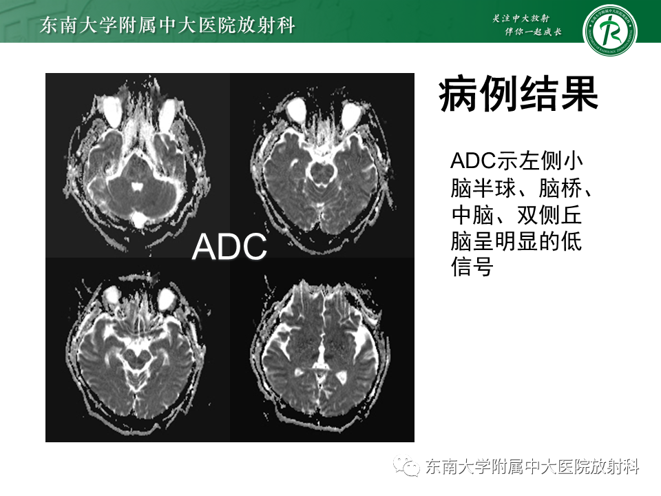 影像PPT - 【PPT】基底动脉尖综合征-5