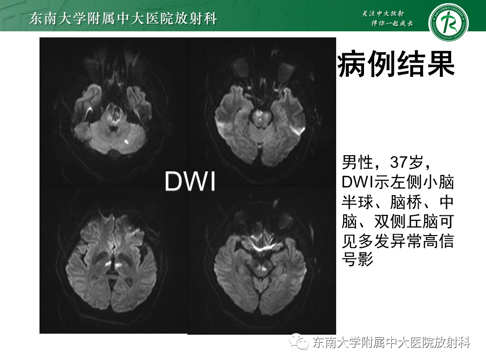 影像PPT - 【PPT】基底动脉尖综合征-4