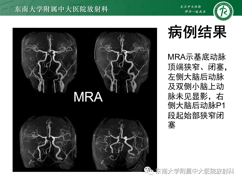 影像PPT - 【PPT】基底动脉尖综合征-6