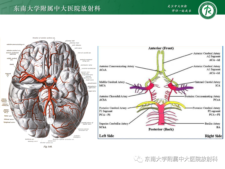 影像PPT - 【PPT】基底动脉尖综合征-10