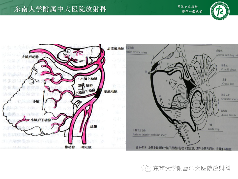 影像PPT - 【PPT】基底动脉尖综合征-14