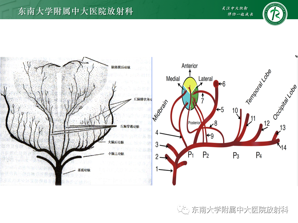 影像PPT - 【PPT】基底动脉尖综合征-12