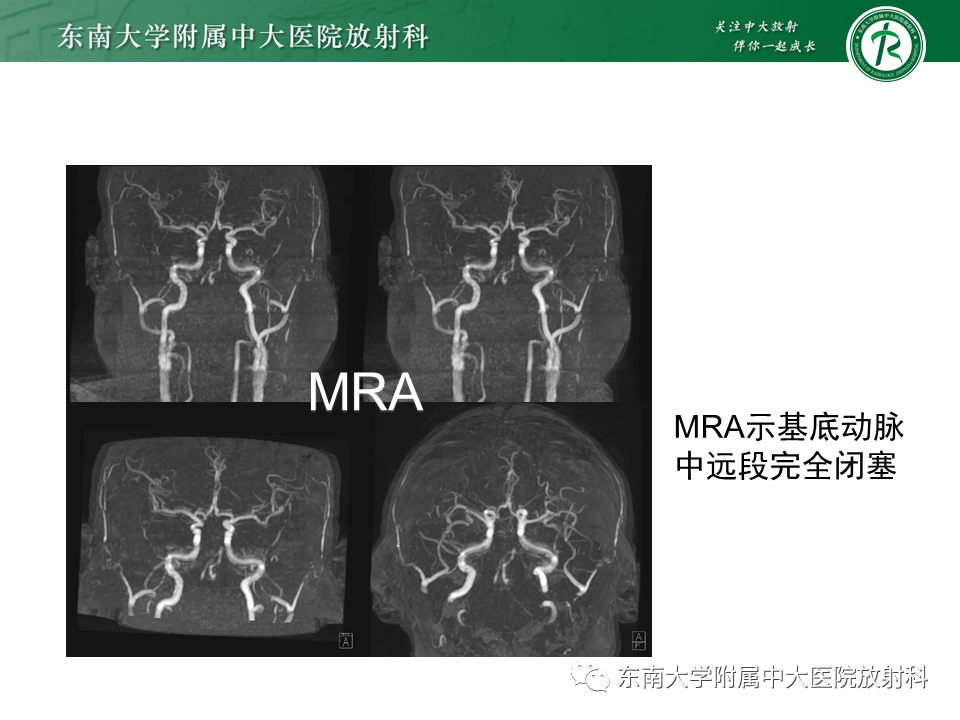 影像PPT - 【PPT】基底动脉尖综合征-26