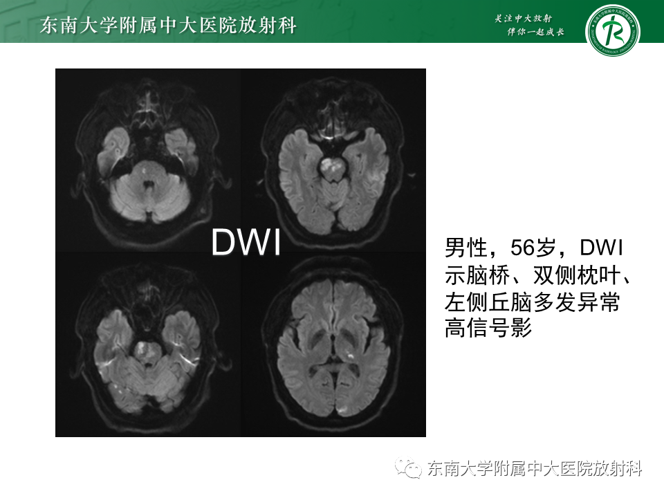 影像PPT - 【PPT】基底动脉尖综合征-25