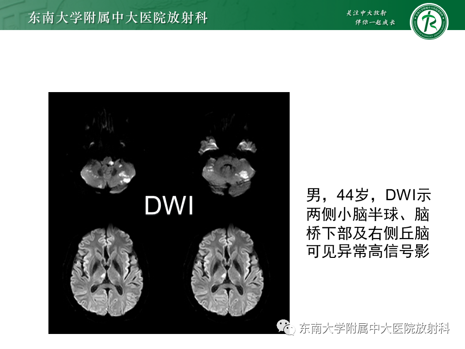 影像PPT - 【PPT】基底动脉尖综合征-27