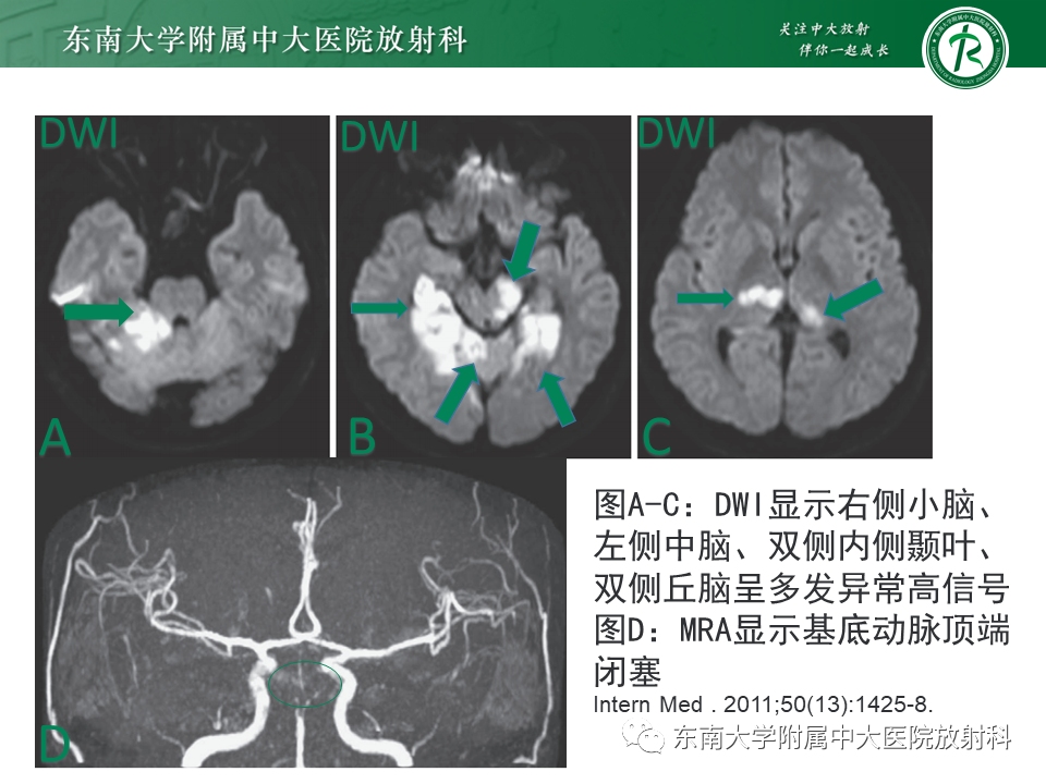 影像PPT - 【PPT】基底动脉尖综合征-29