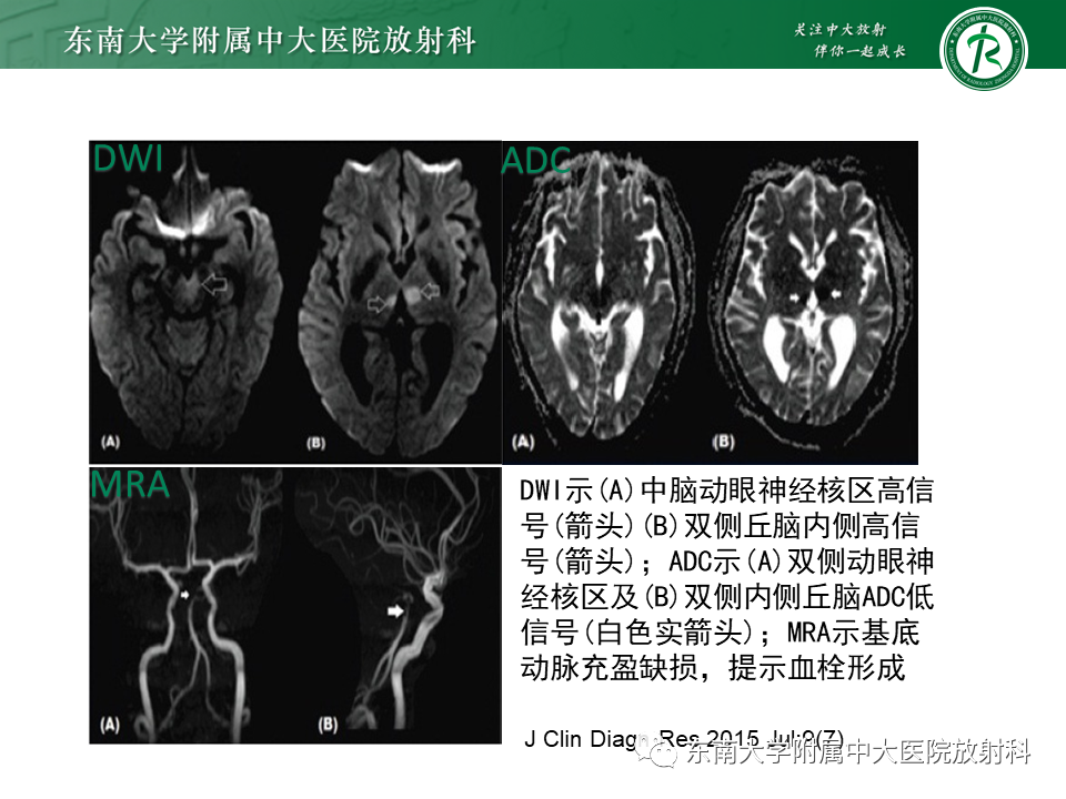 影像PPT - 【PPT】基底动脉尖综合征-30