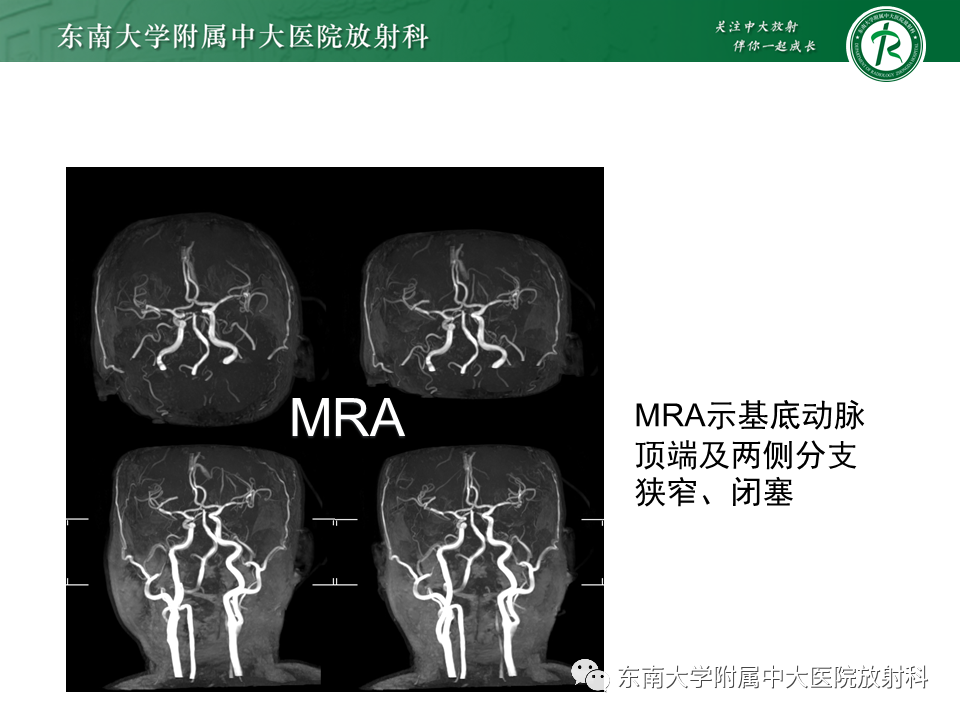 影像PPT - 【PPT】基底动脉尖综合征-28