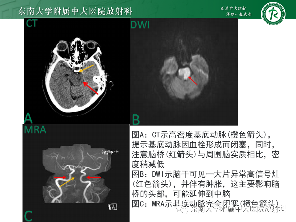 影像PPT - 【PPT】基底动脉尖综合征-33