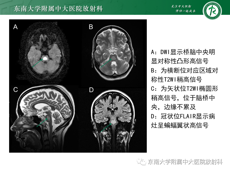 影像PPT - 【PPT】基底动脉尖综合征-37