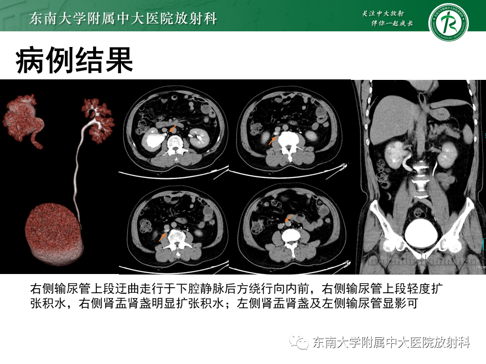 影像PPT - 【PPT】下腔静脉后输尿管及输尿管先天变异-3