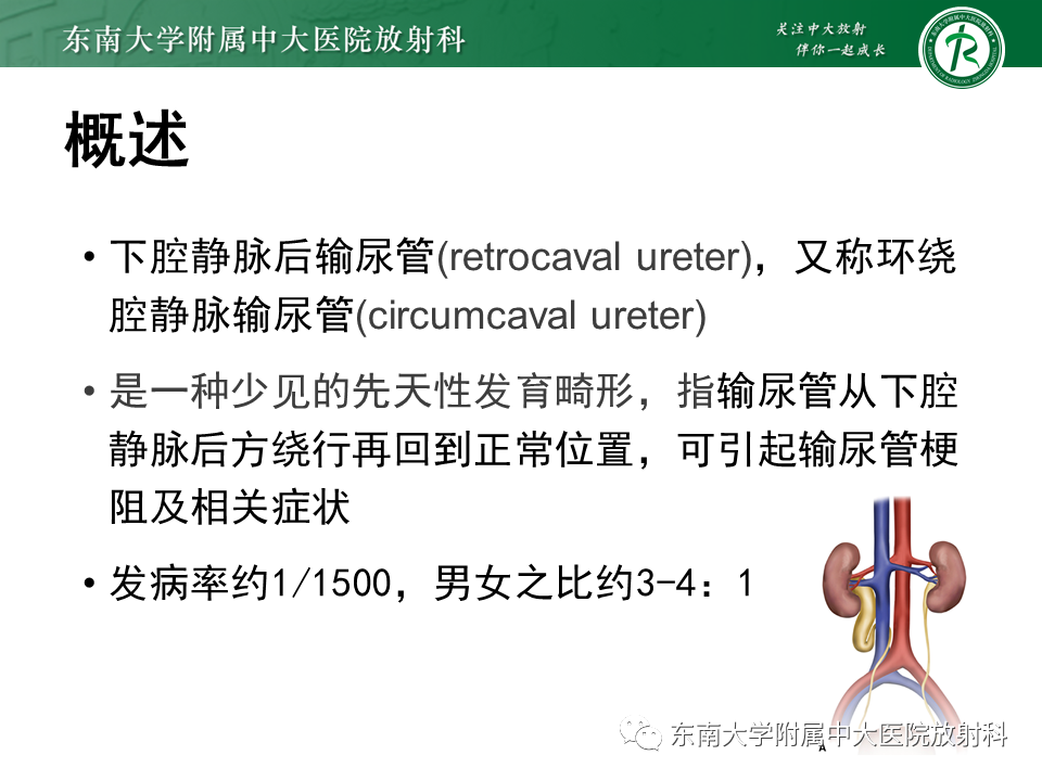 影像PPT - 【PPT】下腔静脉后输尿管及输尿管先天变异-5
