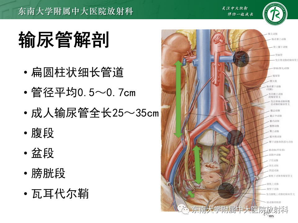 影像PPT - 【PPT】下腔静脉后输尿管及输尿管先天变异-6